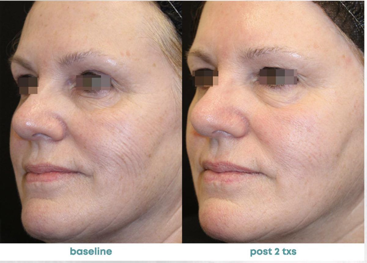 Accent Prime Skin Rejuvenation Renuvia Med Spa New Port Richey