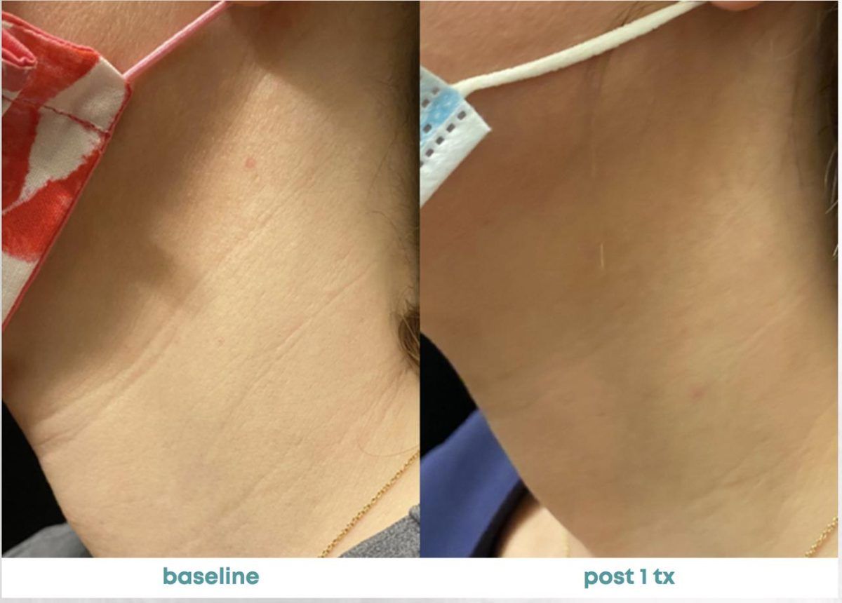 Accent Prime Skin Rejuvenation Renuvia Med Spa New Port Richey