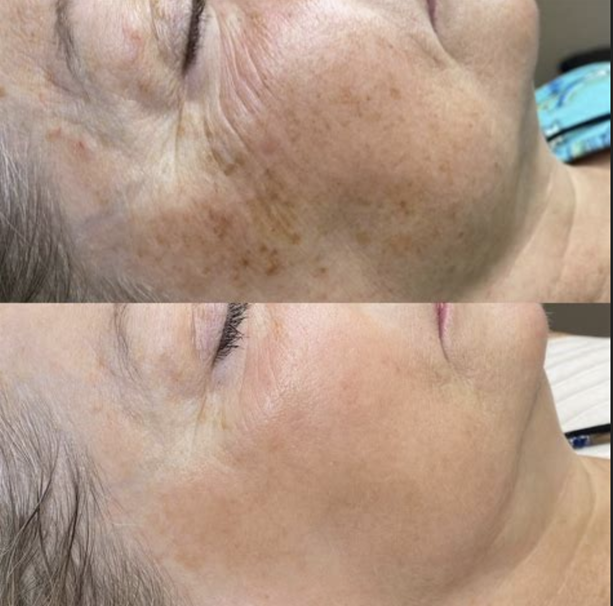 DYE VL Skin Rejuvenation Renuvia Med Spa New Port Richey