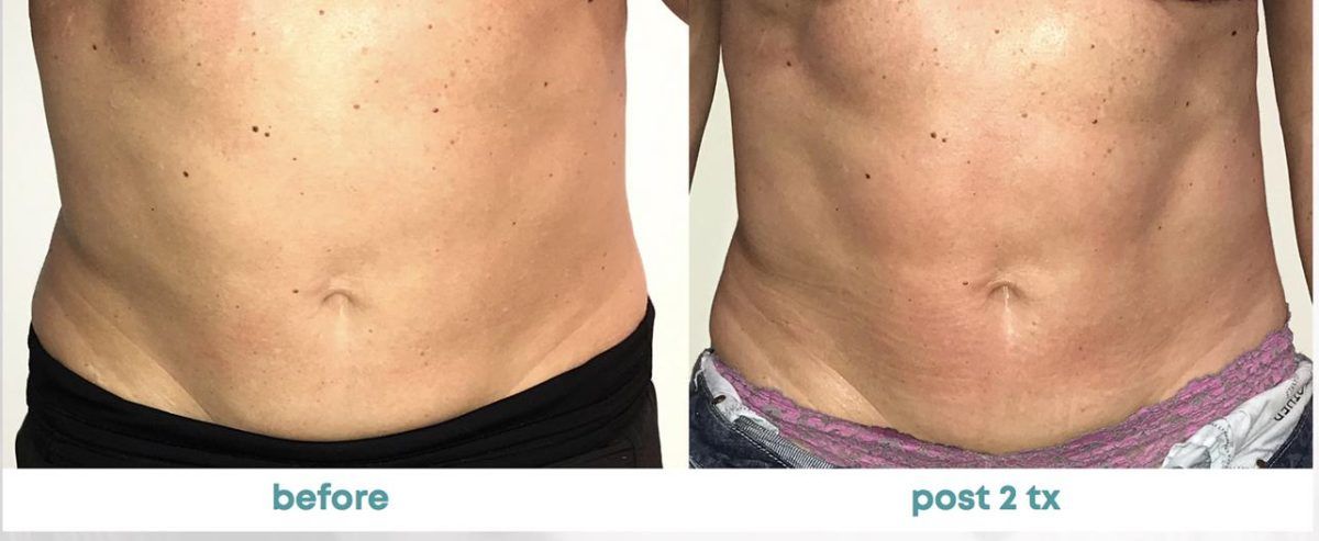 Accent Prime Skin Rejuvenation Renuvia Med Spa New Port Richey