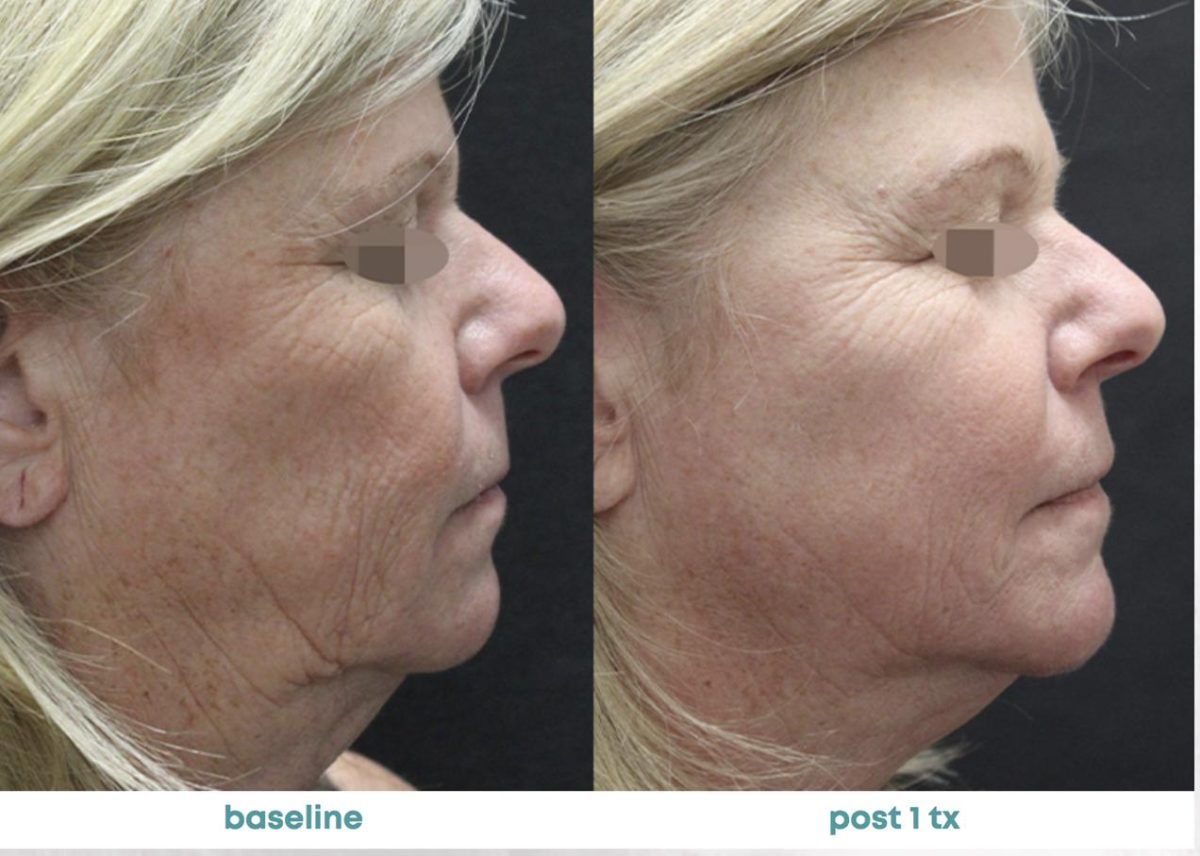 Accent Prime Skin Rejuvenation Renuvia Med Spa New Port Richey