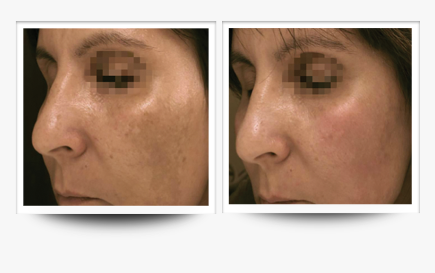 Accent Prime Skin Rejuvenation Renuvia Med Spa New Port Richey