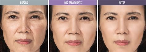 Accent Prime Skin Rejuvenation Renuvia Med Spa New Port Richey