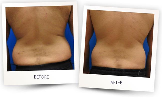 Accent Prime Skin Rejuvenation Renuvia Med Spa New Port Richey