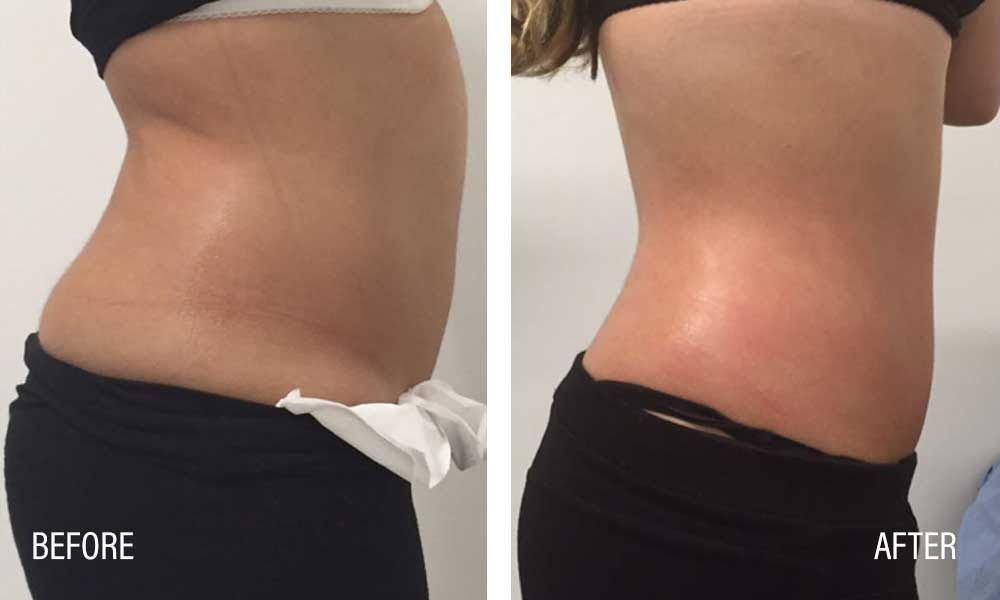 Accent Prime Skin Rejuvenation Renuvia Med Spa New Port Richey