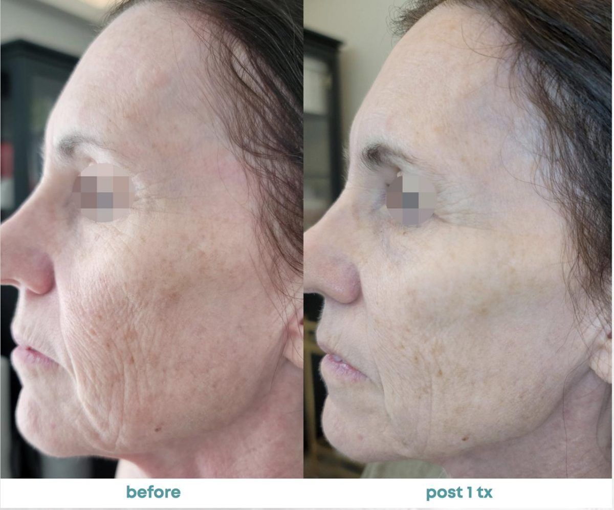 Accent Prime Skin Rejuvenation Renuvia Med Spa New Port Richey