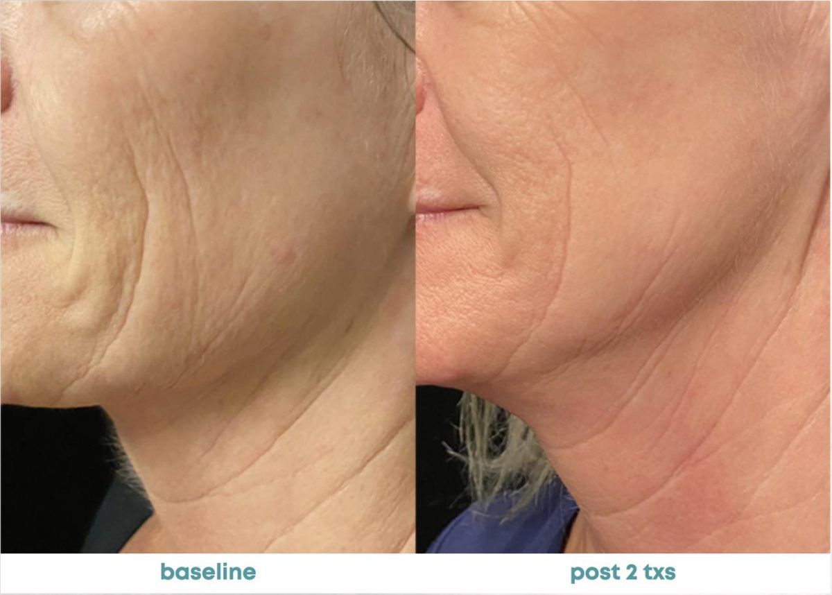Accent Prime Skin Rejuvenation Renuvia Med Spa New Port Richey