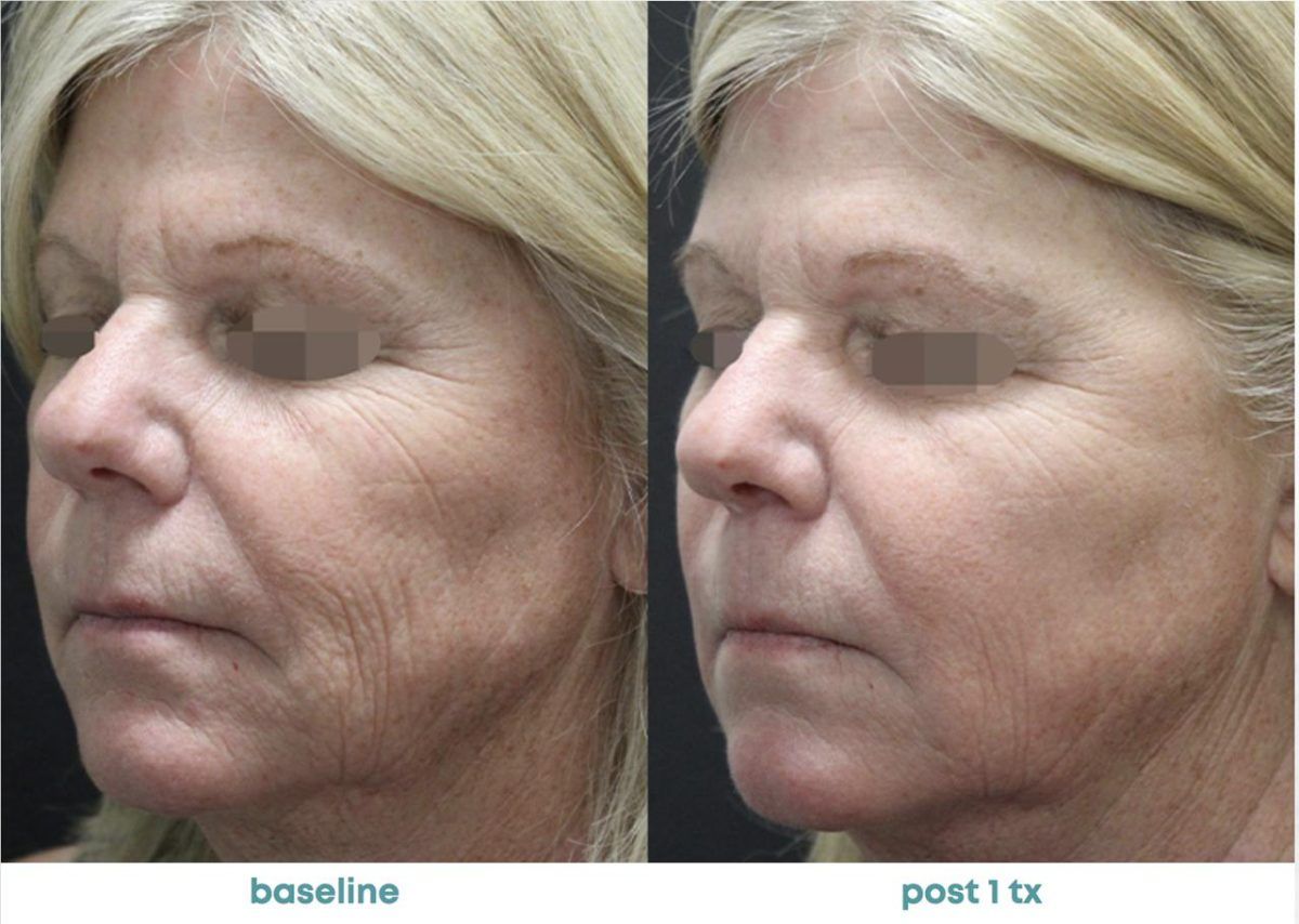 Accent Prime Skin Rejuvenation Renuvia Med Spa New Port Richey