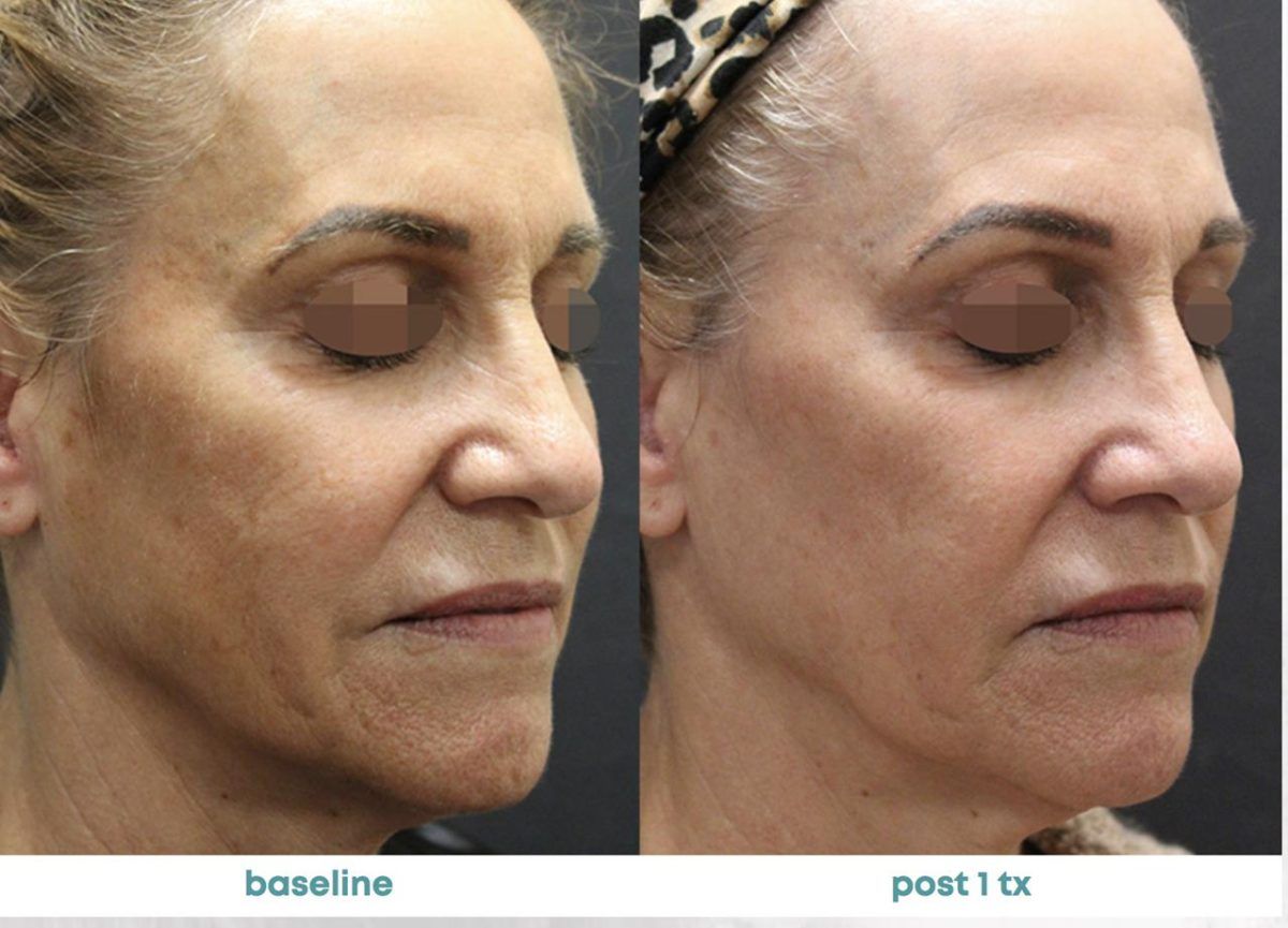 Accent Prime Skin Rejuvenation Renuvia Med Spa New Port Richey