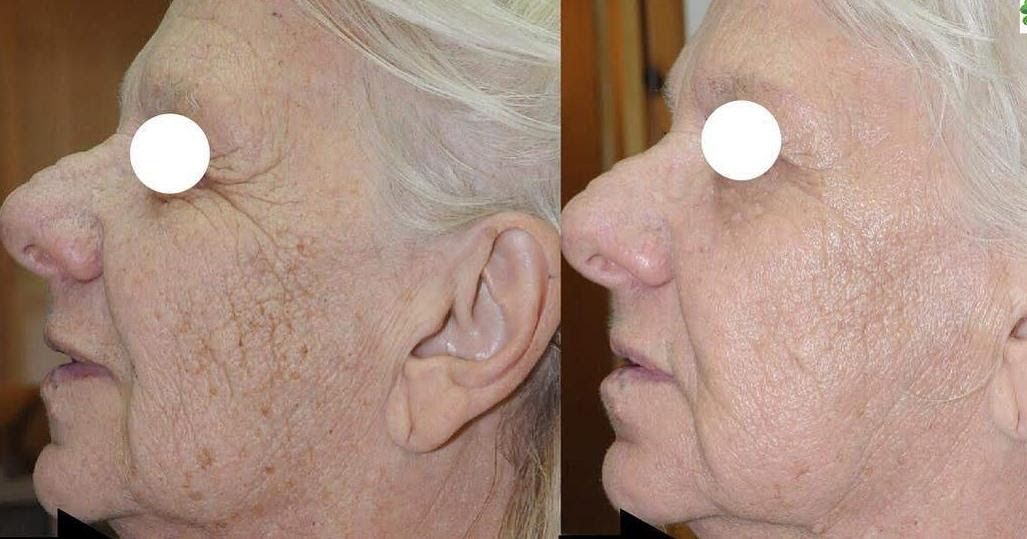 CO2 Laser Skin Rejuvenation Renuvia Med Spa New Port Richey