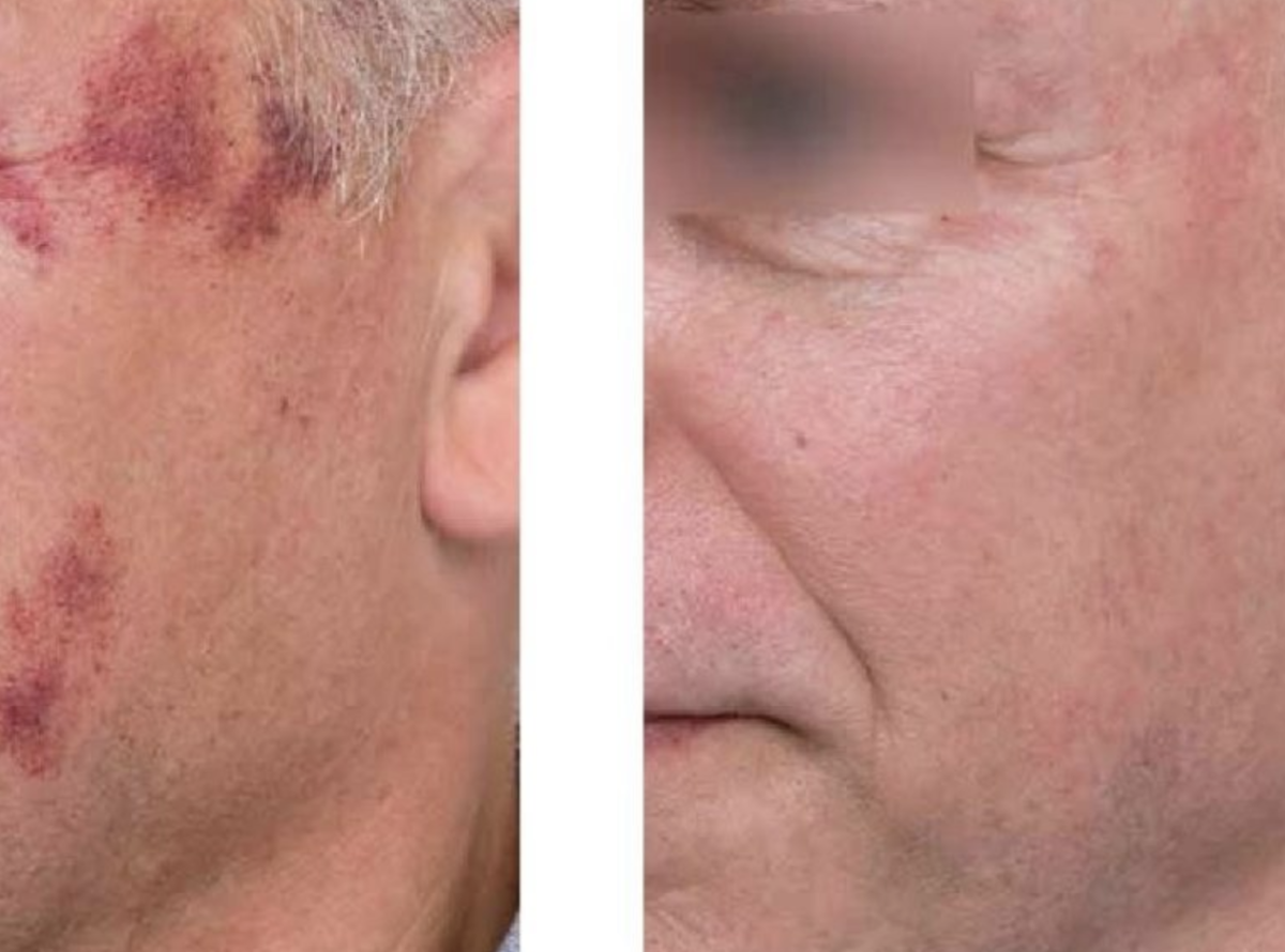 DYE VL Skin Rejuvenation Renuvia Med Spa New Port Richey
