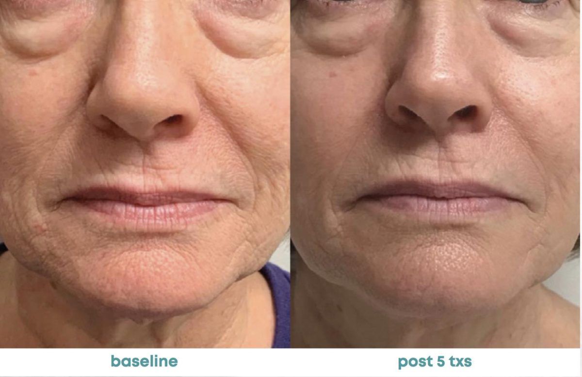 Accent Prime Skin Rejuvenation Renuvia Med Spa New Port Richey