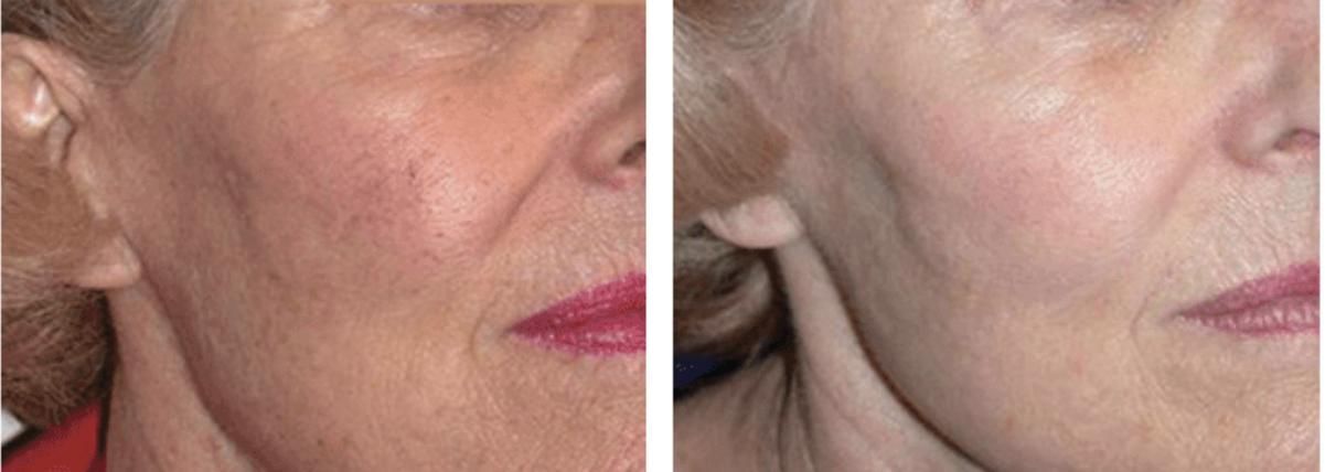 DYE VL Skin Rejuvenation Renuvia Med Spa New Port Richey