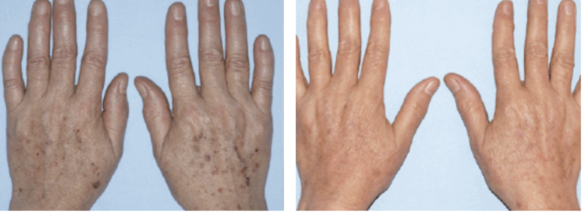 DYE VL Skin Rejuvenation Renuvia Med Spa New Port Richey