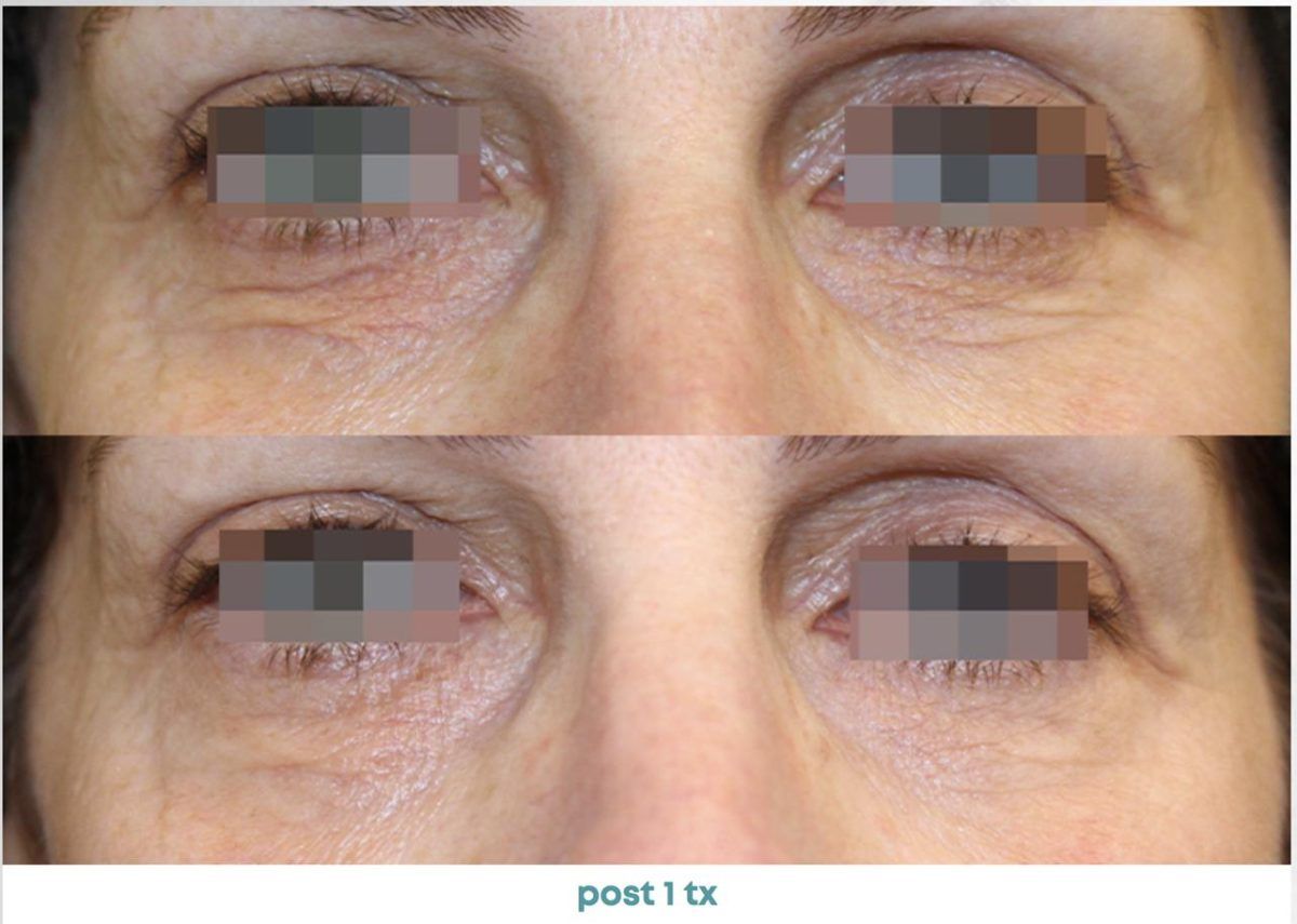 Accent Prime Skin Rejuvenation Renuvia Med Spa New Port Richey