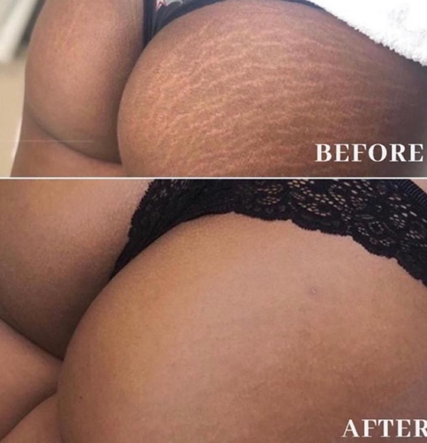 Accent Prime Skin Rejuvenation Renuvia Med Spa New Port Richey