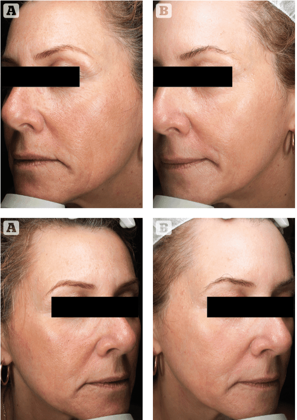 Accent Prime Skin Rejuvenation Renuvia Med Spa New Port Richey