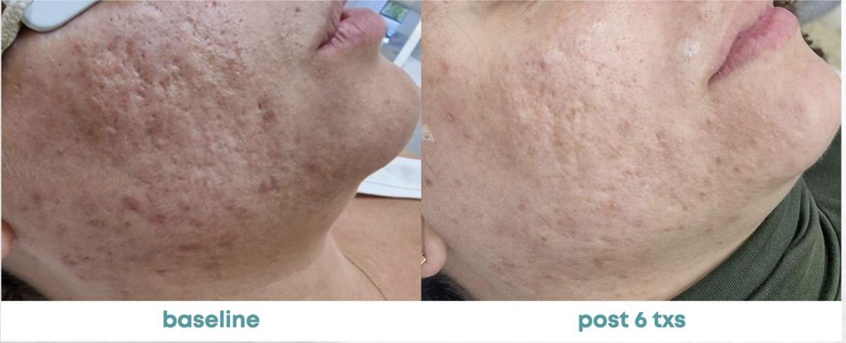 Accent Prime Skin Rejuvenation Renuvia Med Spa New Port Richey