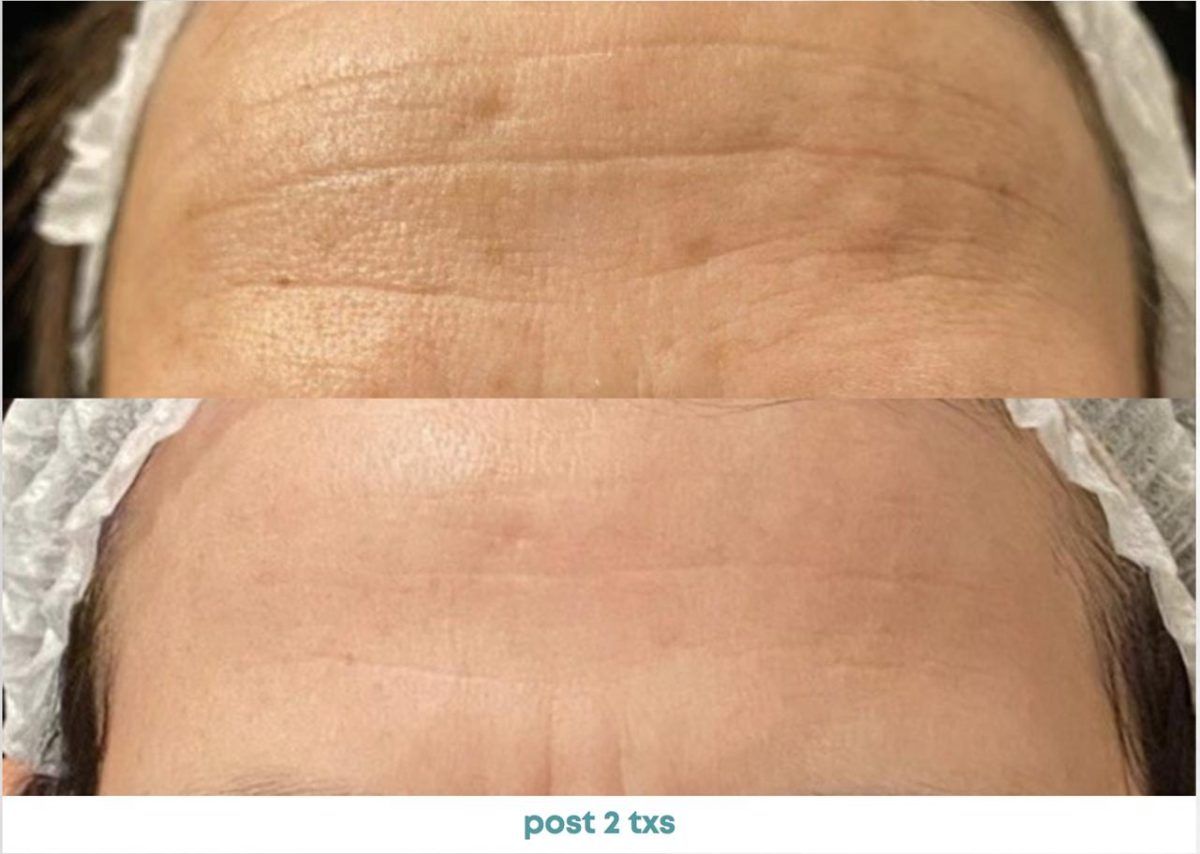 Accent Prime Skin Rejuvenation Renuvia Med Spa New Port Richey