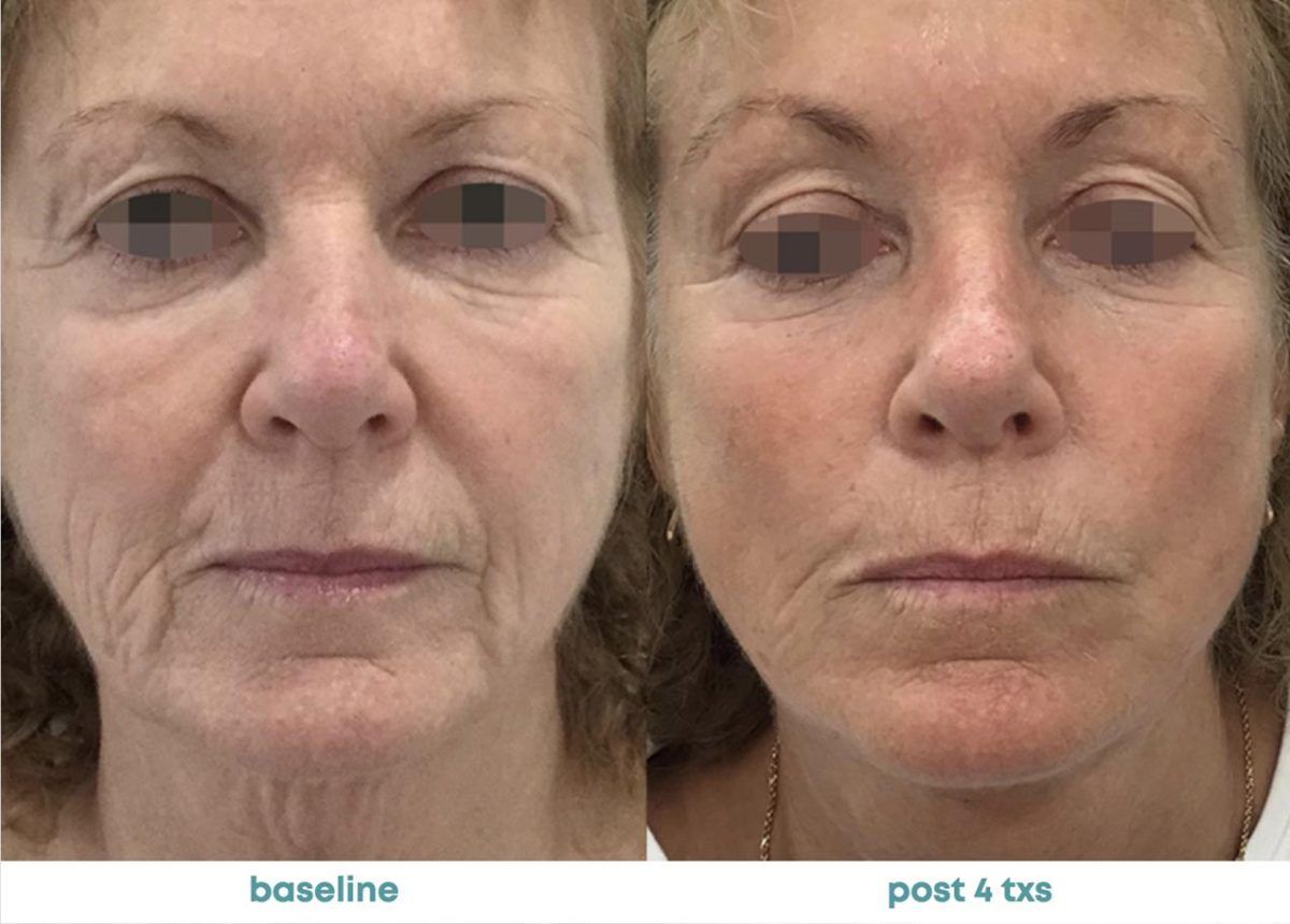 Accent Prime Skin Rejuvenation Renuvia Med Spa New Port Richey