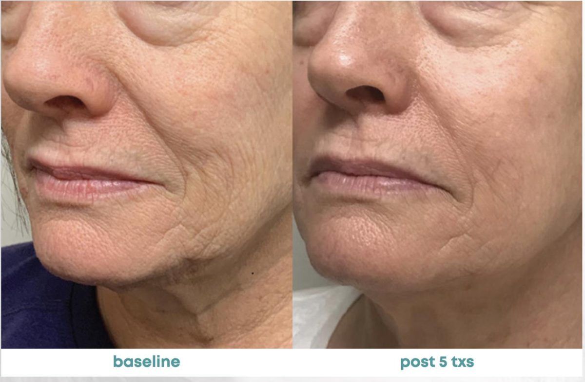 Accent Prime Skin Rejuvenation Renuvia Med Spa New Port Richey