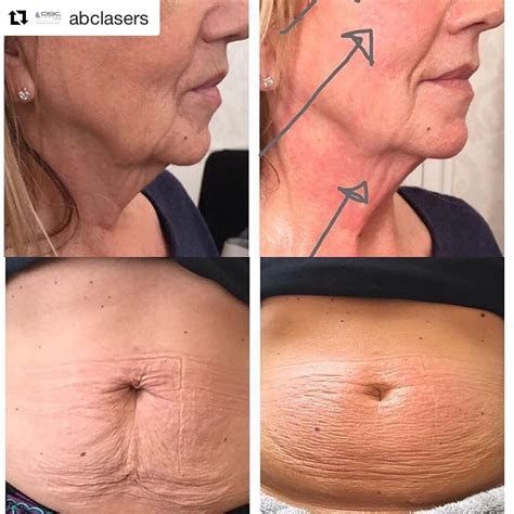 Accent Prime Skin Rejuvenation Renuvia Med Spa New Port Richey