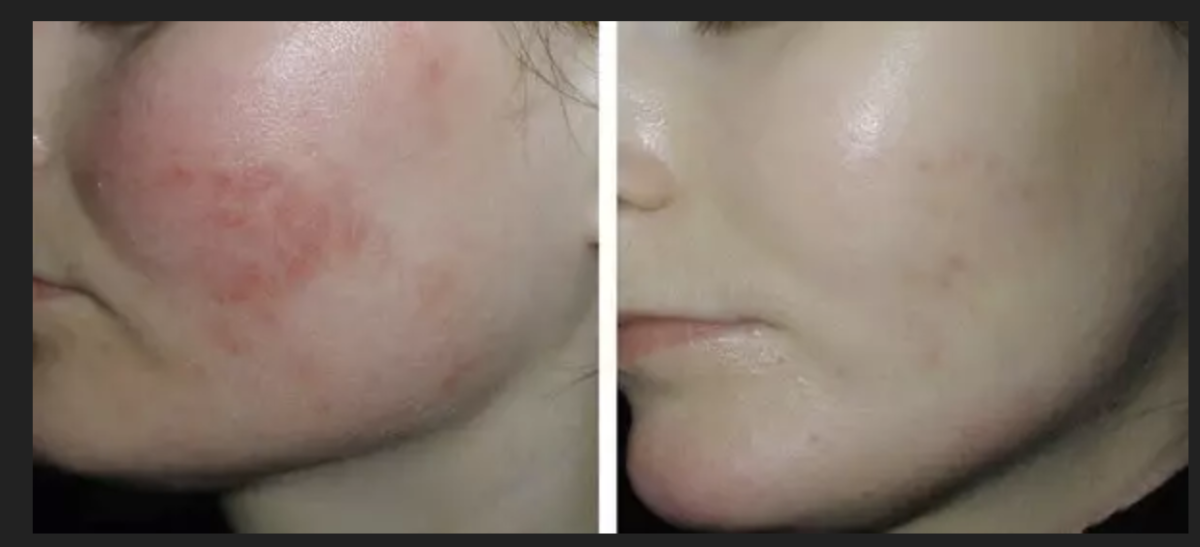 DYE VL Skin Rejuvenation Renuvia Med Spa New Port Richey