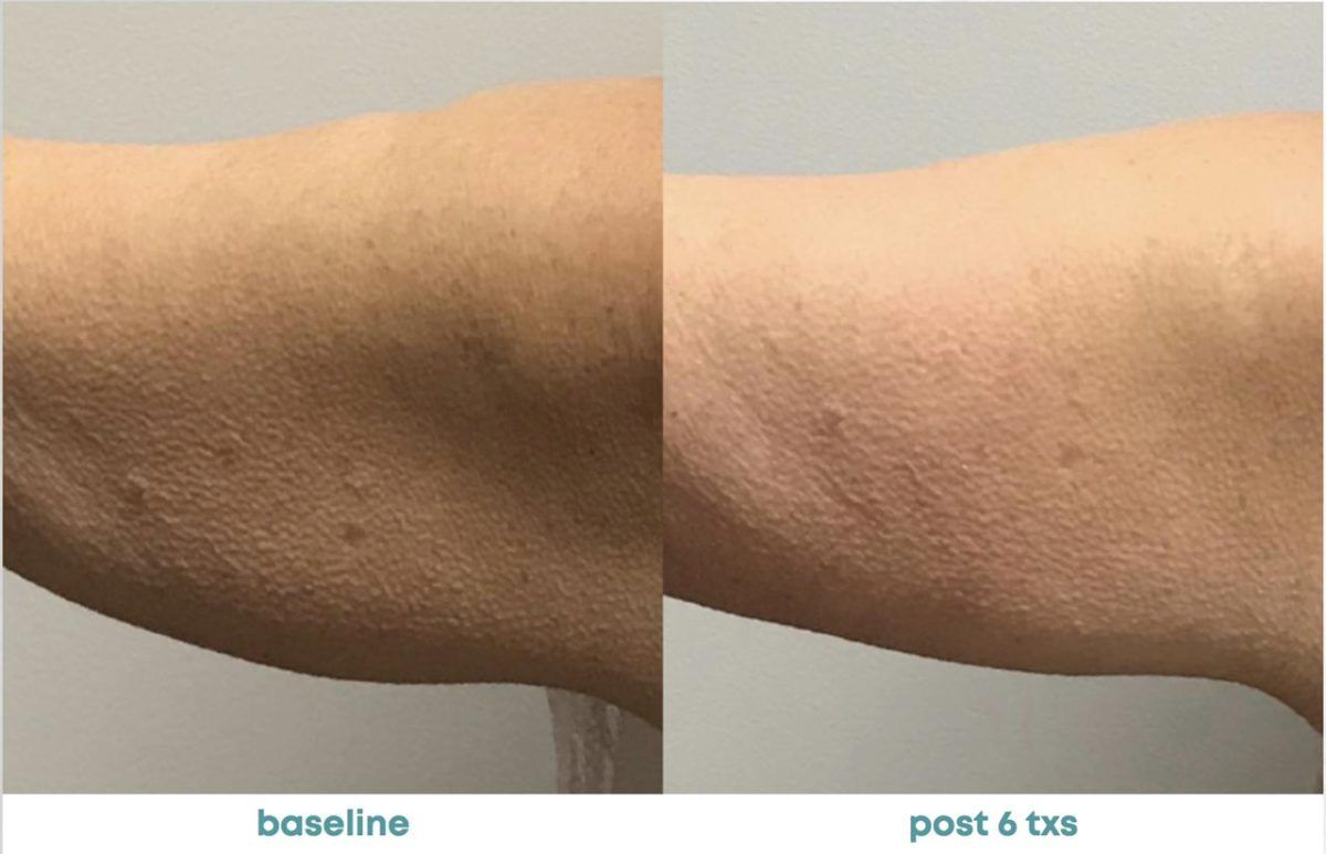 Accent Prime Skin Rejuvenation Renuvia Med Spa New Port Richey