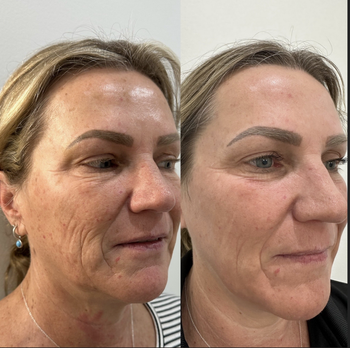 CO2 Laser Skin Rejuvenation Renuvia Med Spa New Port Richey