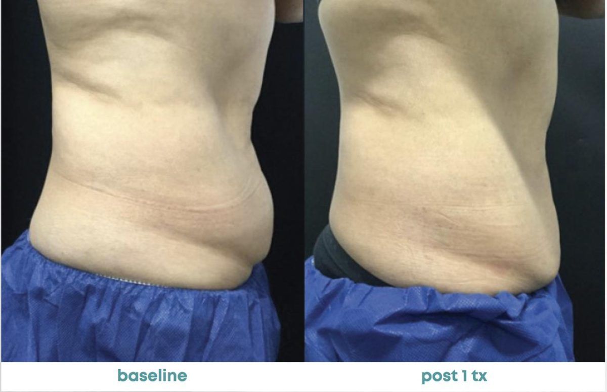 Accent Prime Skin Rejuvenation Renuvia Med Spa New Port Richey