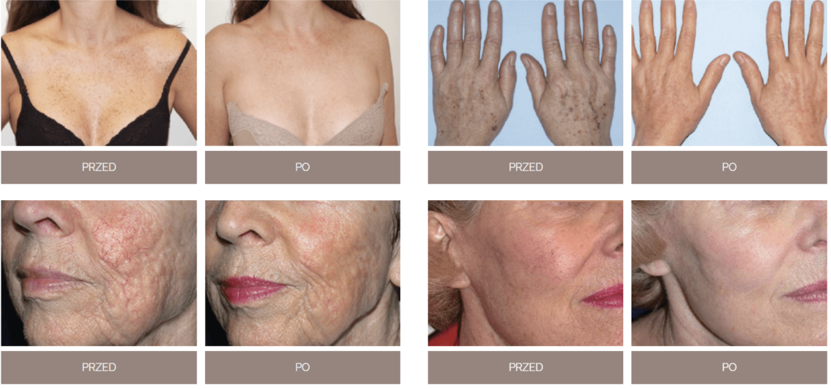 DYE VL Skin Rejuvenation Renuvia Med Spa New Port Richey